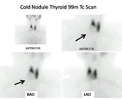 C:\Documents and Settings\Usuario\Escritorio\Cold nodule.jpg